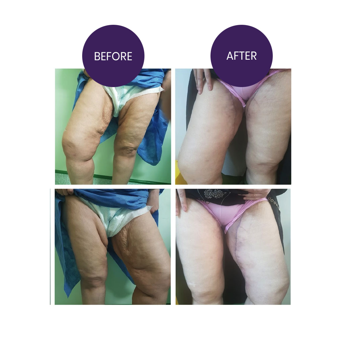 Thigh Lift Surgery