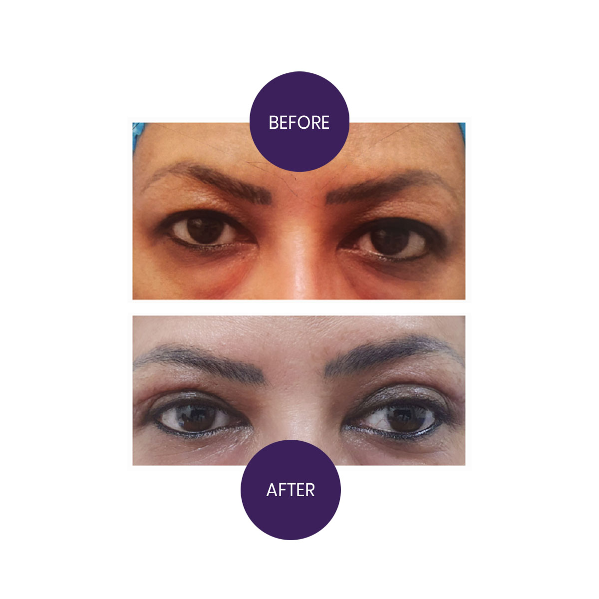 Blepharoplasty for Eye Rejuvenation