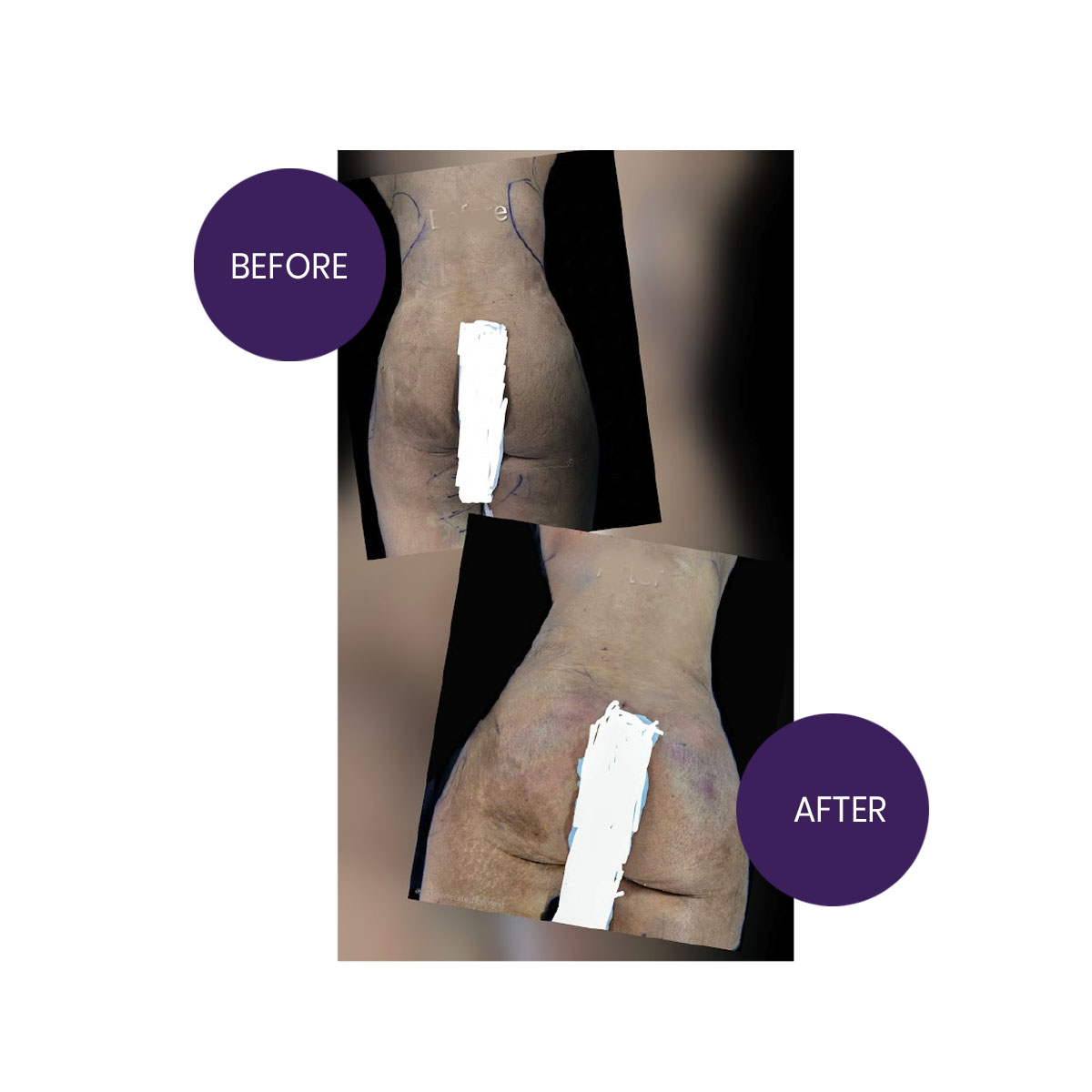 BBL Surgery