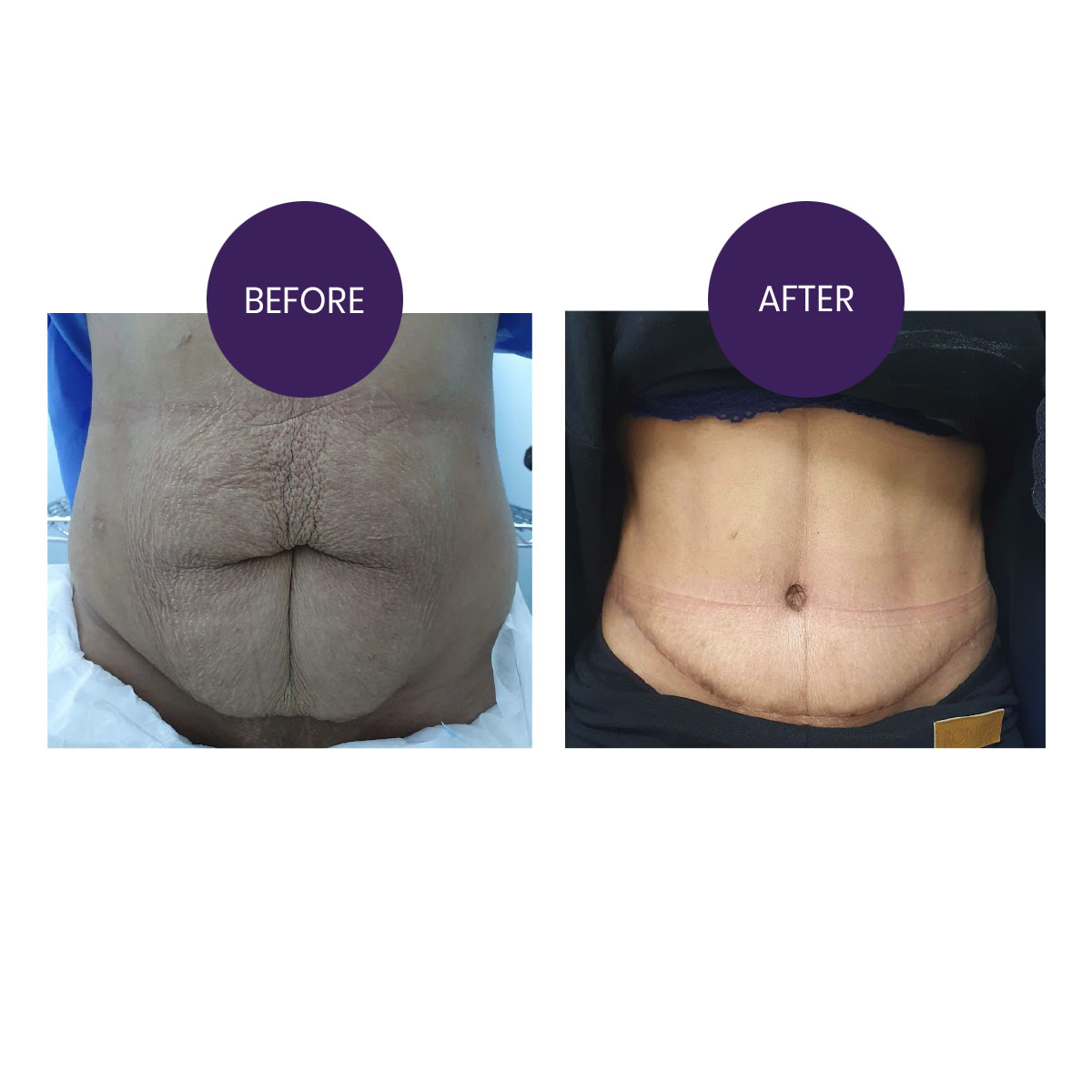 ABDOMINOPLASTY( TUMMY TUCK SURGERY)