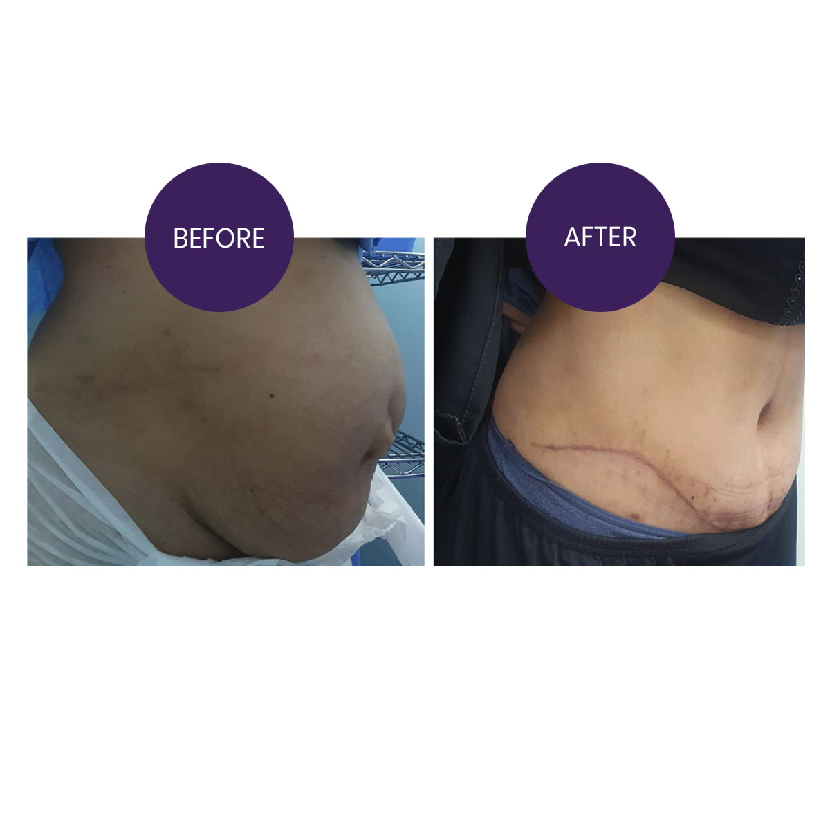 Abdominoplasty with umbilical reconstruction