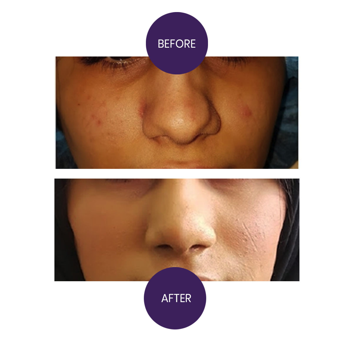 Rhinoplasty-Hump reduction