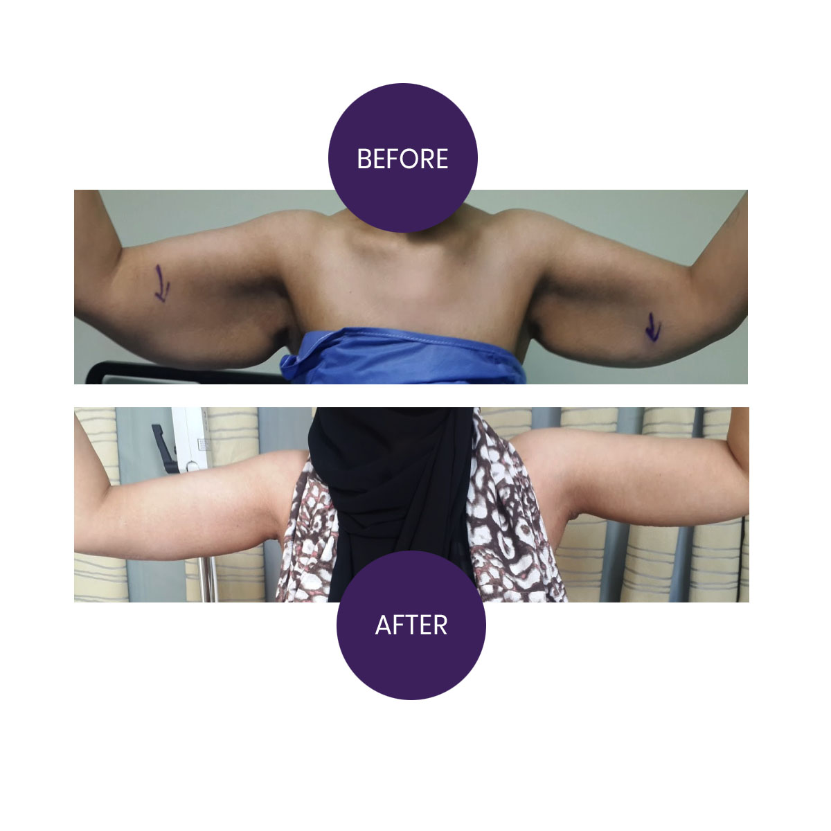 ARM LIFT ( Brachioplasty)