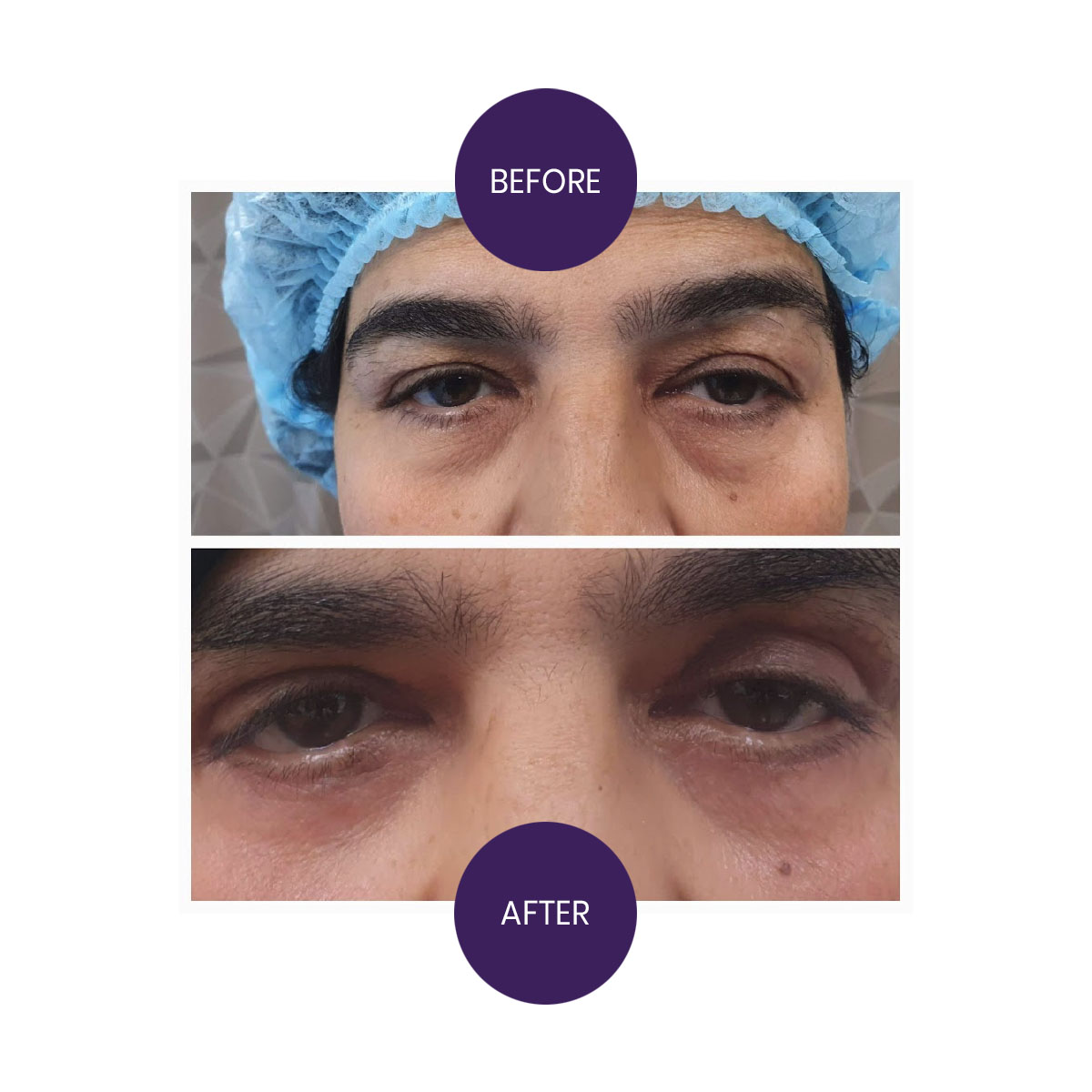 Blepharoplasty