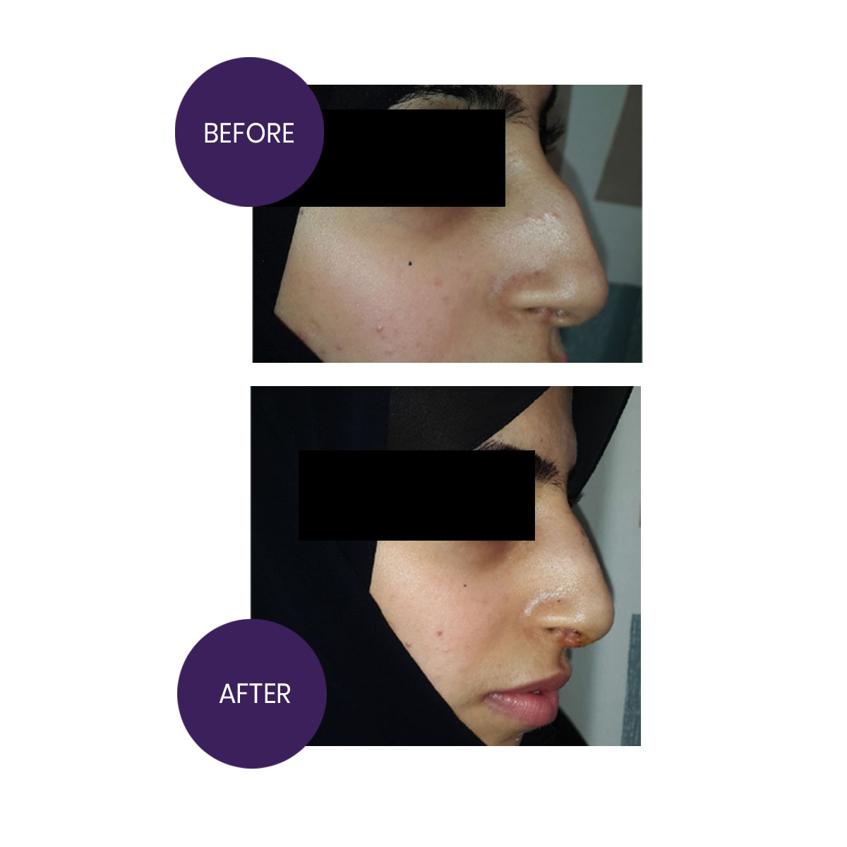 Rhinoplasty-Hump reduction