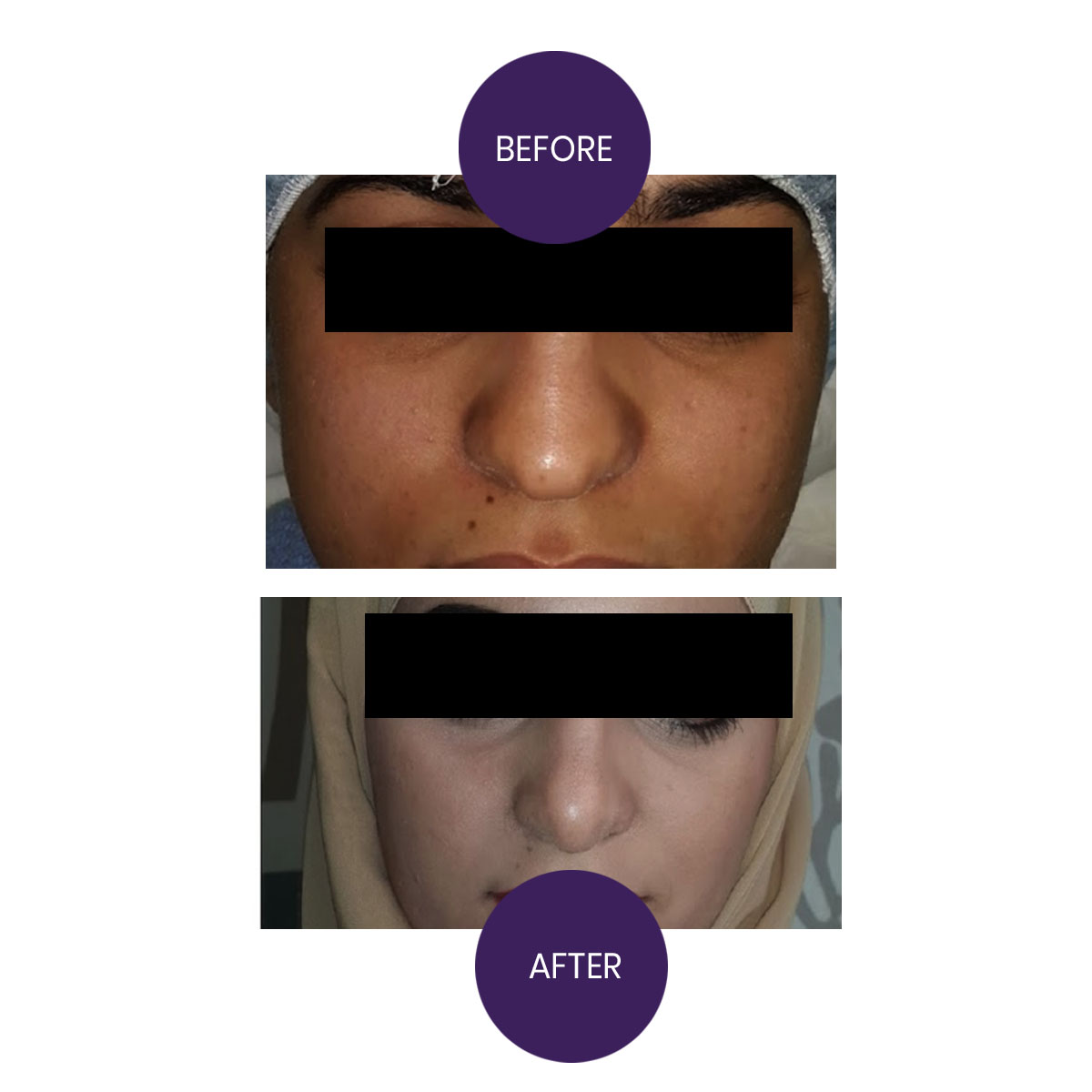 Rhinoplasty-Hump reduction