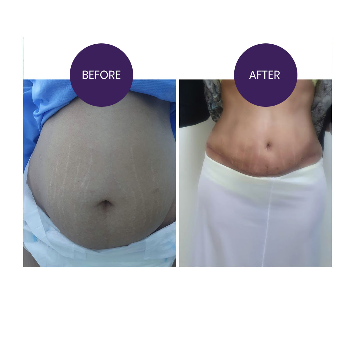 ABDOMINOPLASTY( TUMMY TUCK SURGERY)