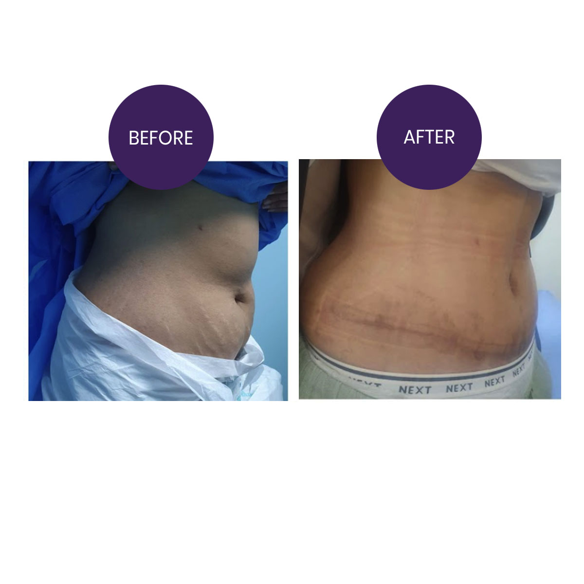 ABDOMINOPLASTY( TUMMY TUCK SURGERY)