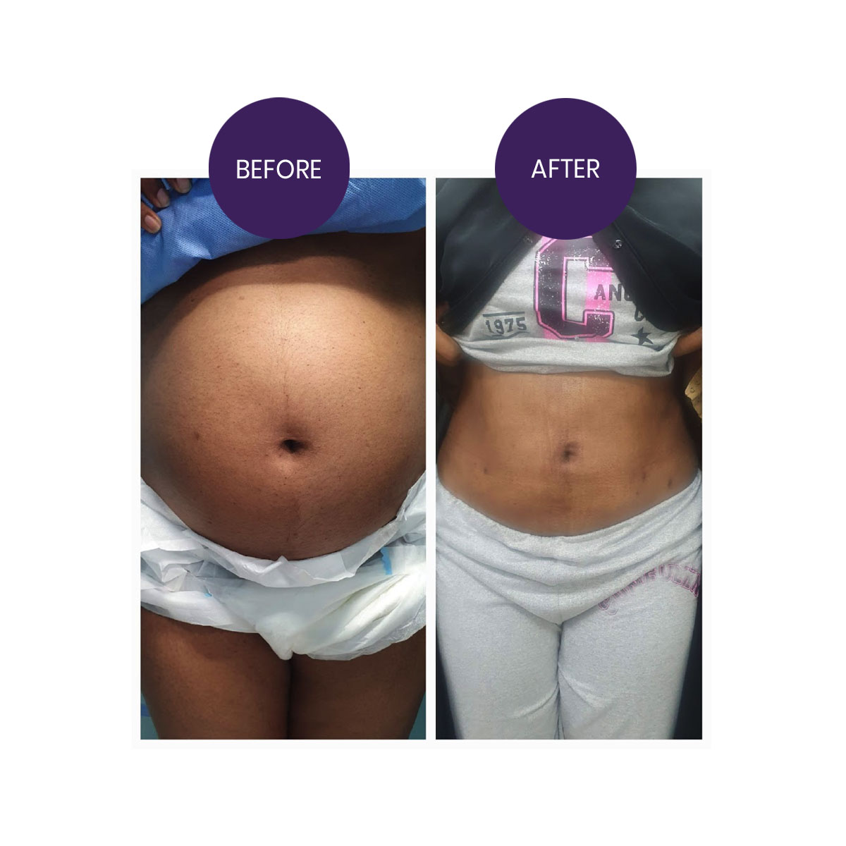 Liposuction Abdomen