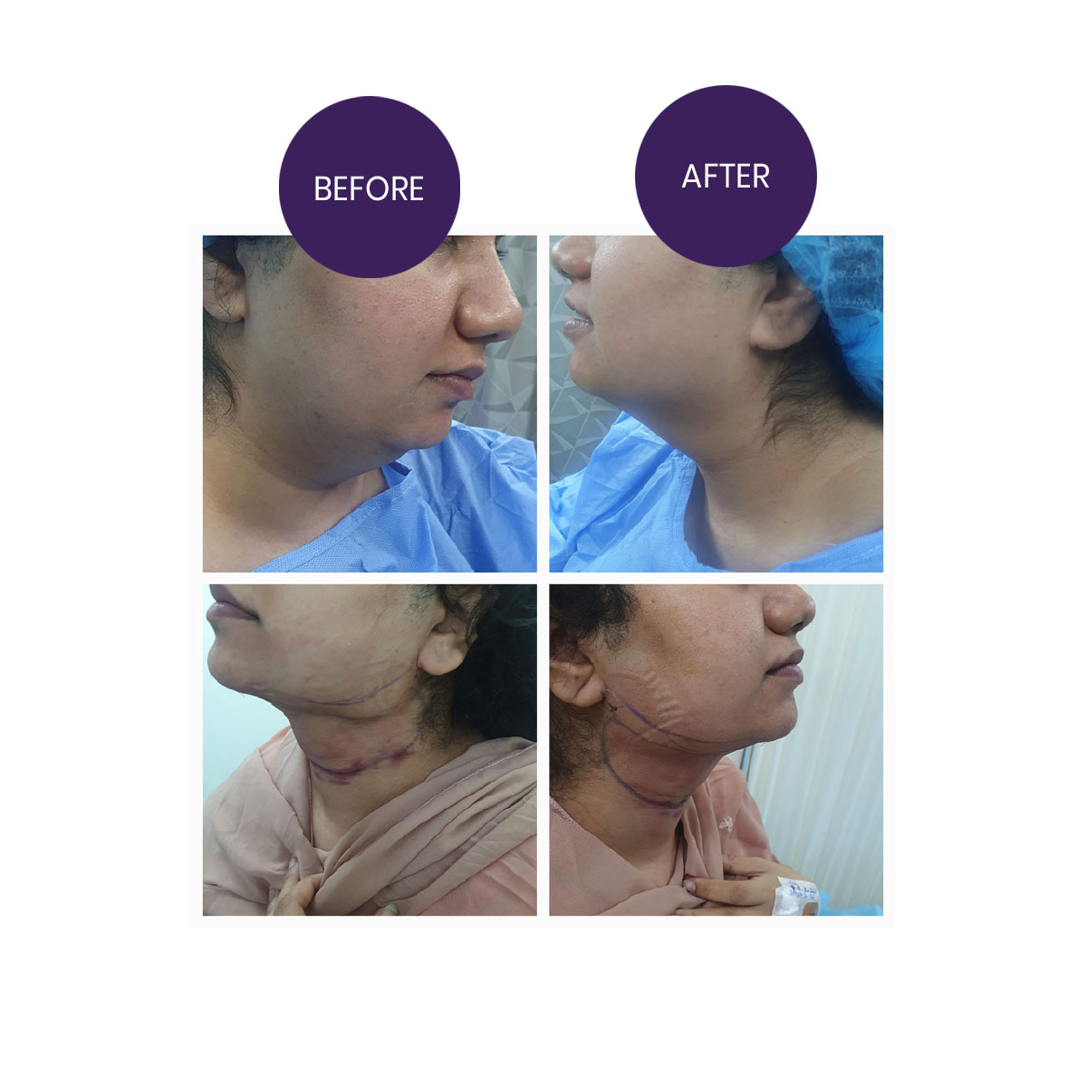 Double Chin Correction (Chin Liposuction)