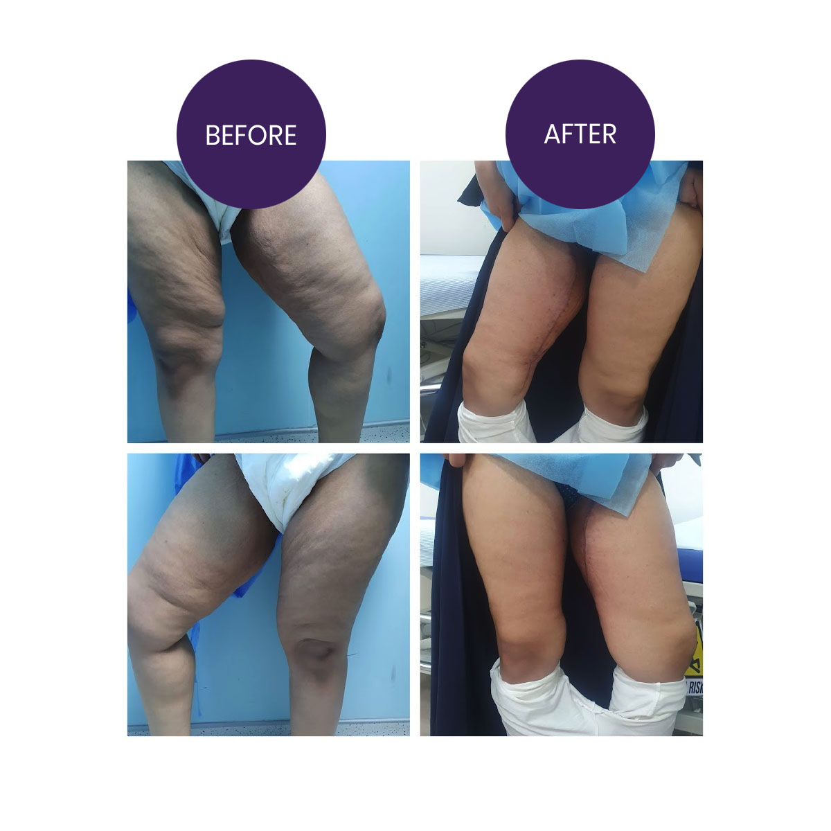 Thigh Lift Surgery