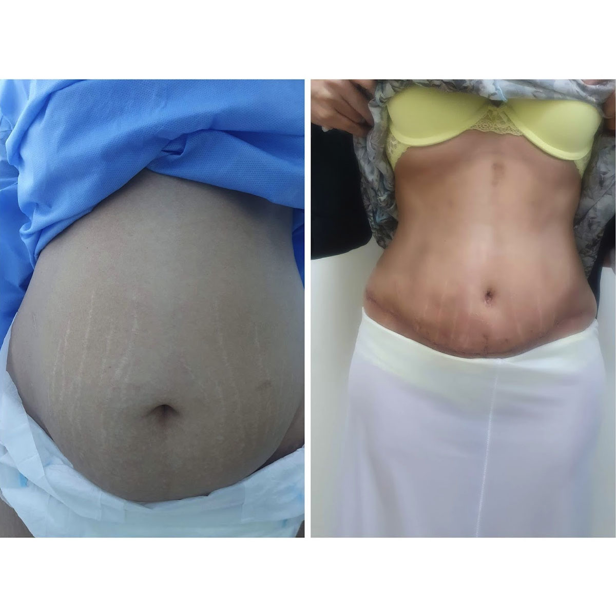 Tummy Tuck (Abdominoplasty) And Mommy Makeover