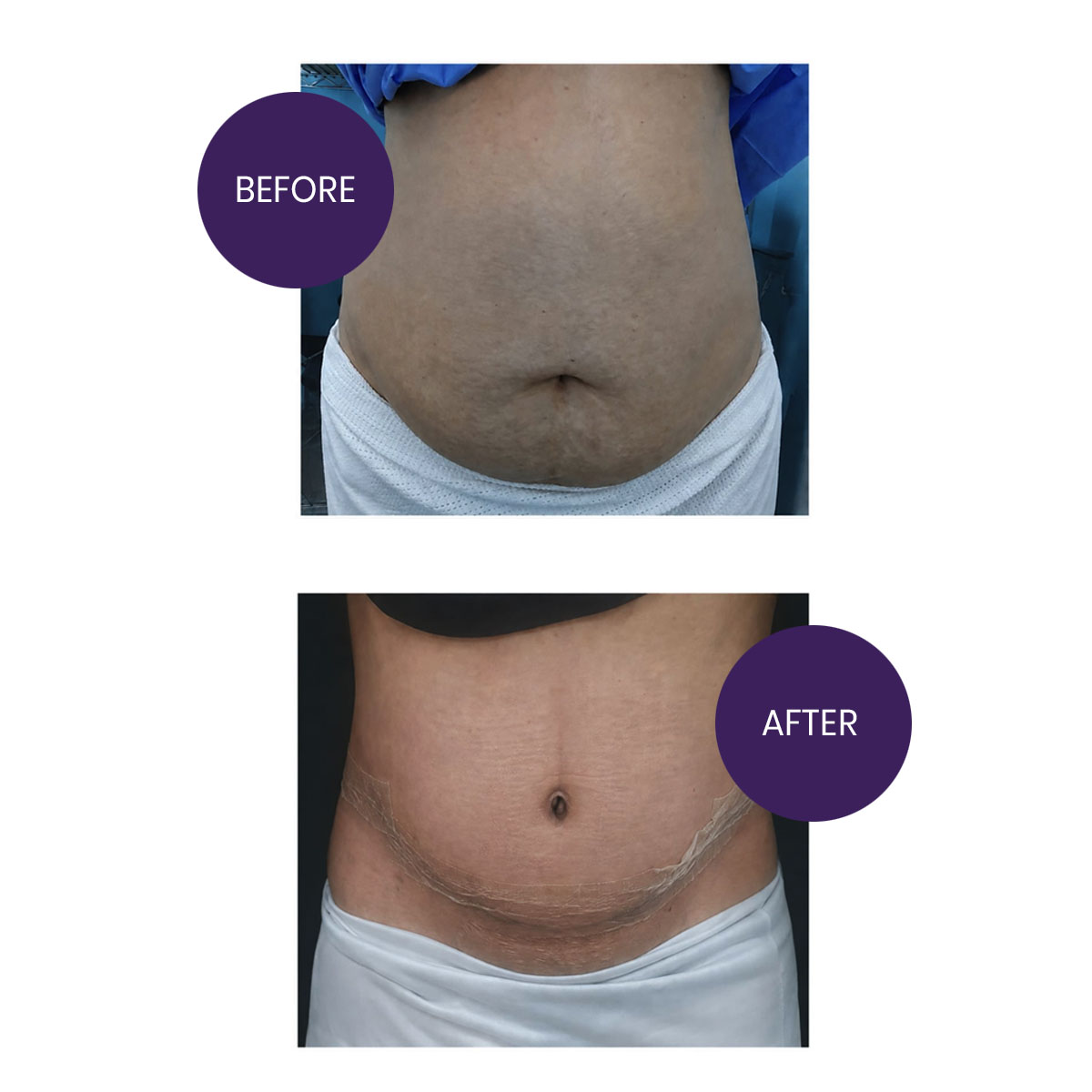 ABDOMINOPLASTY( TUMMY TUCK SURGERY)