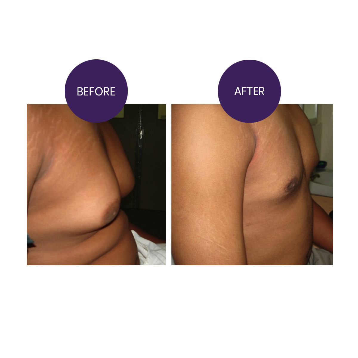 Gynecomastia ( Male breast reduction)