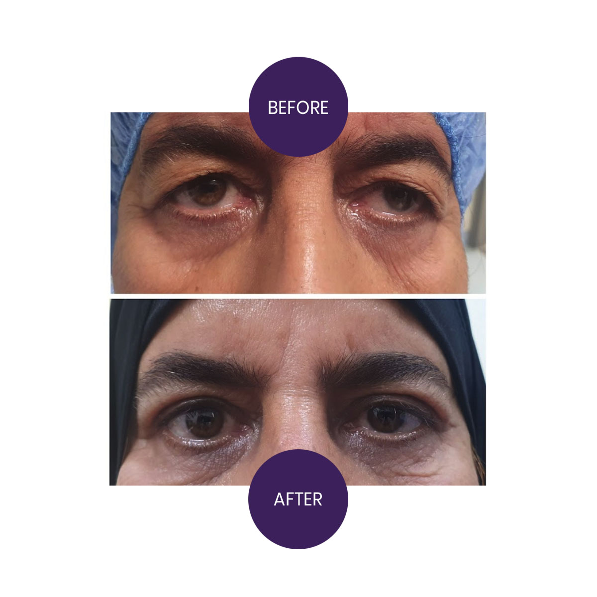 Blepharoplasty for Eye Rejuvenation