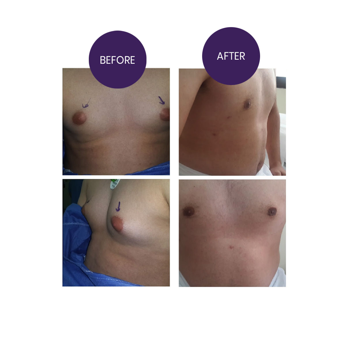 Gynecomastia ( Male breast reduction)