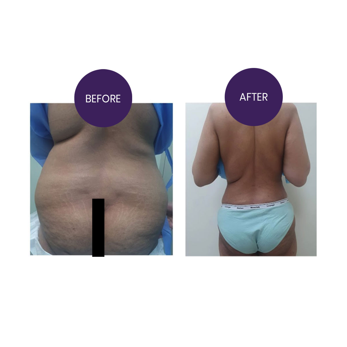 360 Degrees Liposuction