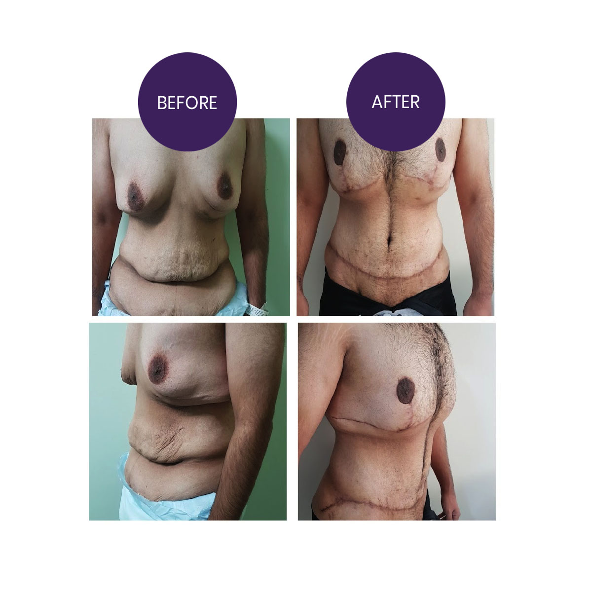 Male Mastopexy