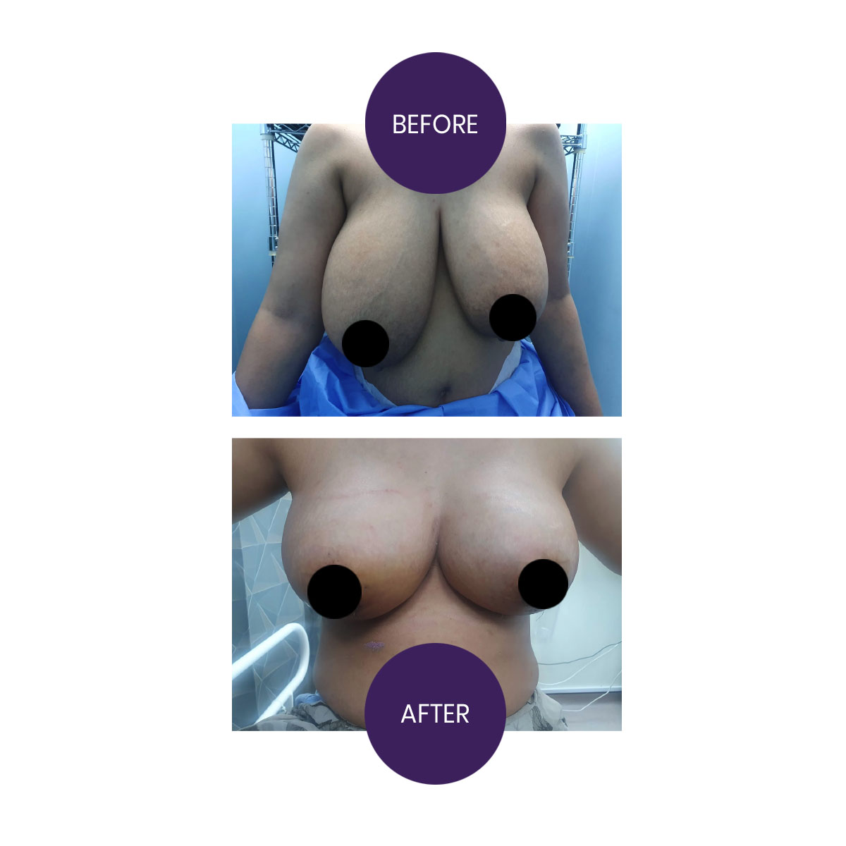 Breast Reduction